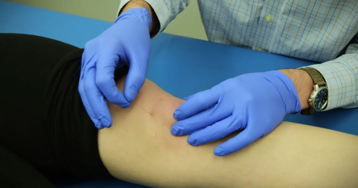 A clinician placing a dry needling needle into a patient's thigh